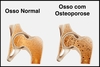 Osteoporose atinge duzentos milhões de mulheres no Brasil